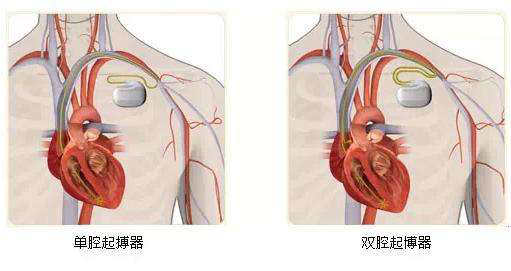 【门诊信息】市二院北区将开设起搏器程控随访门诊