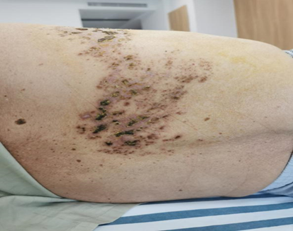 看84岁老伯如何打败“疼痛之王”——带状疱疹性神经痛