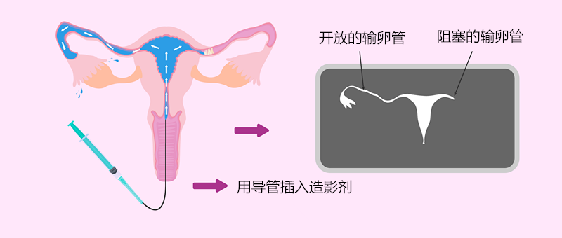 卵 管 造影 検査 後 妊娠 した 人